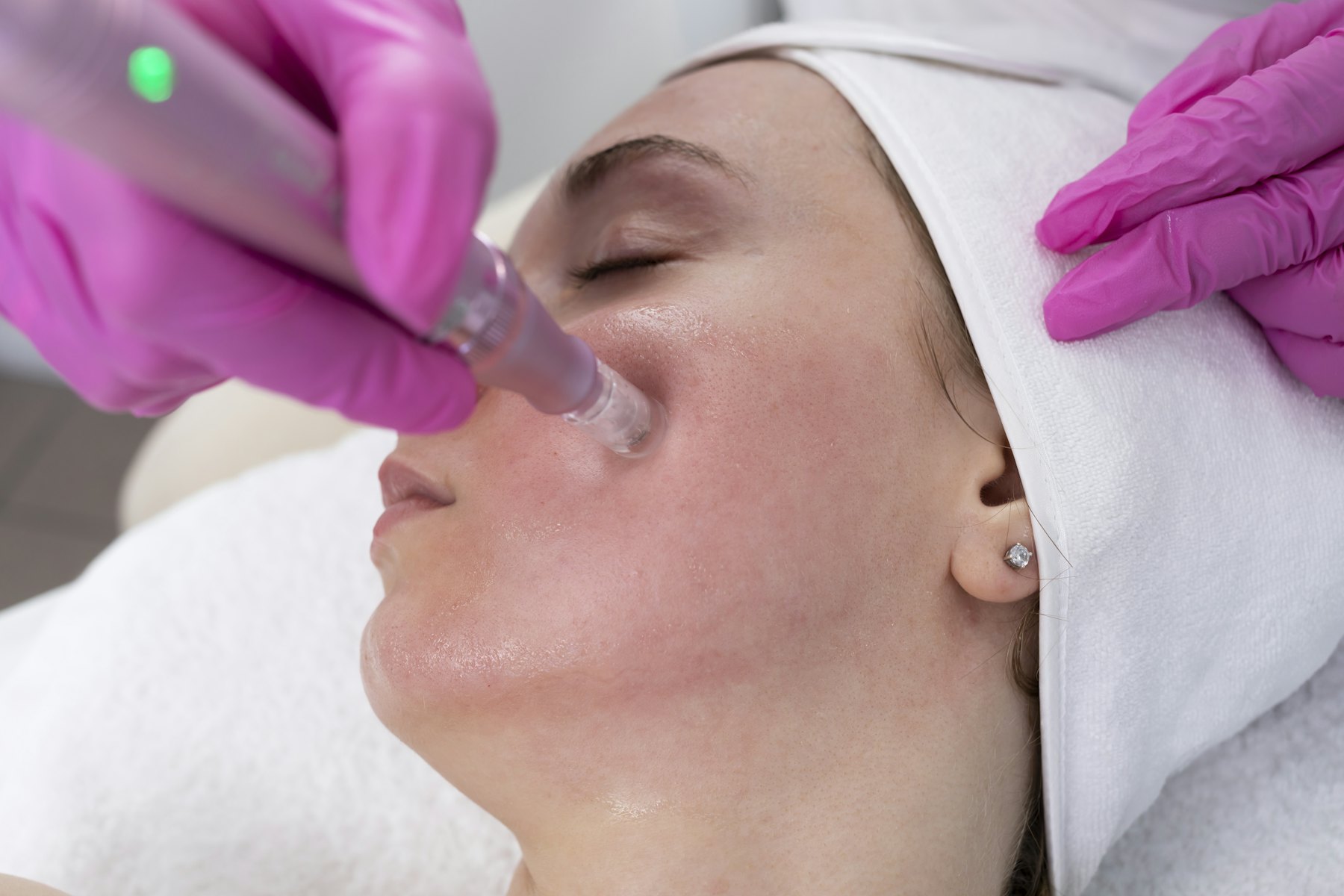 A microneedling treatment